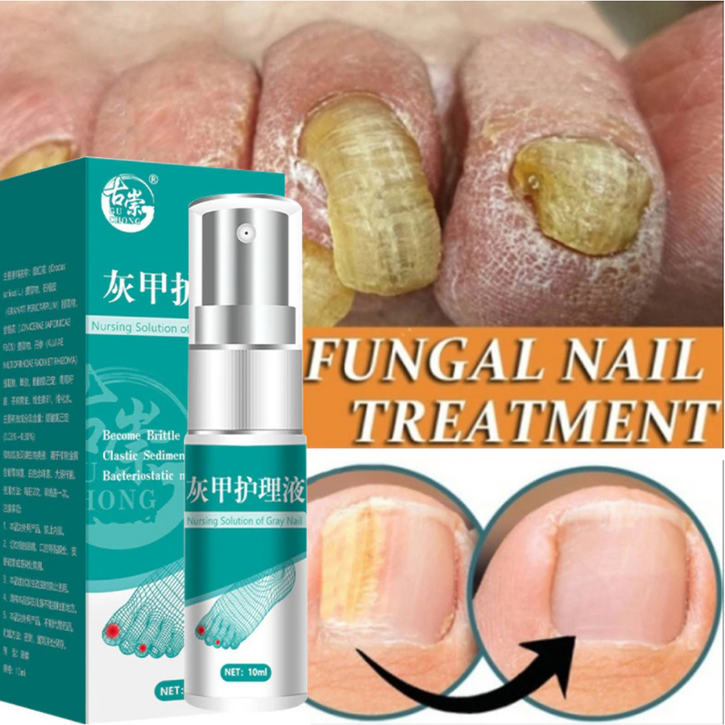 Nail Fungus Treatments Highly Effective Serum Spray Repair Toenail