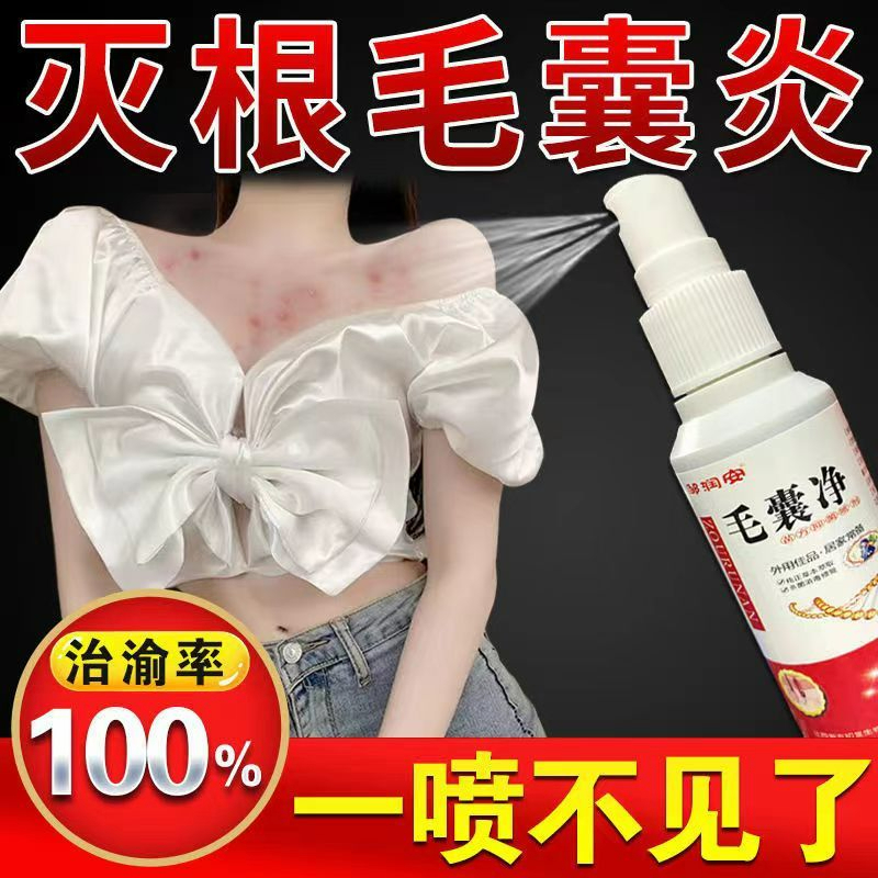 Folliculitis Kexing Pustule Special Spray for Acne, Scalp, Head, and