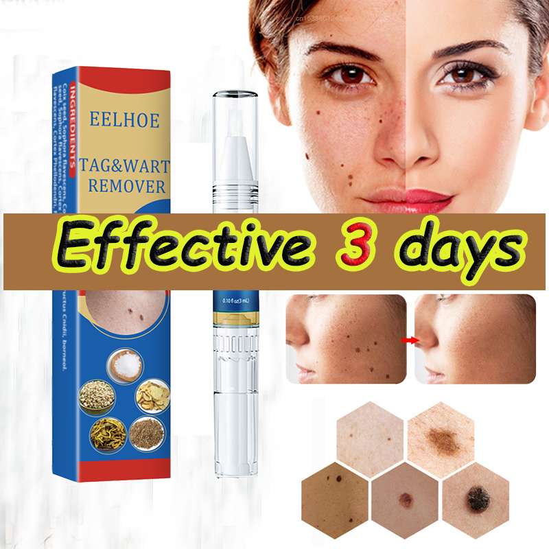 Mole Remover Removing Wart Cream Pure Natural Extracts Healthy Safe