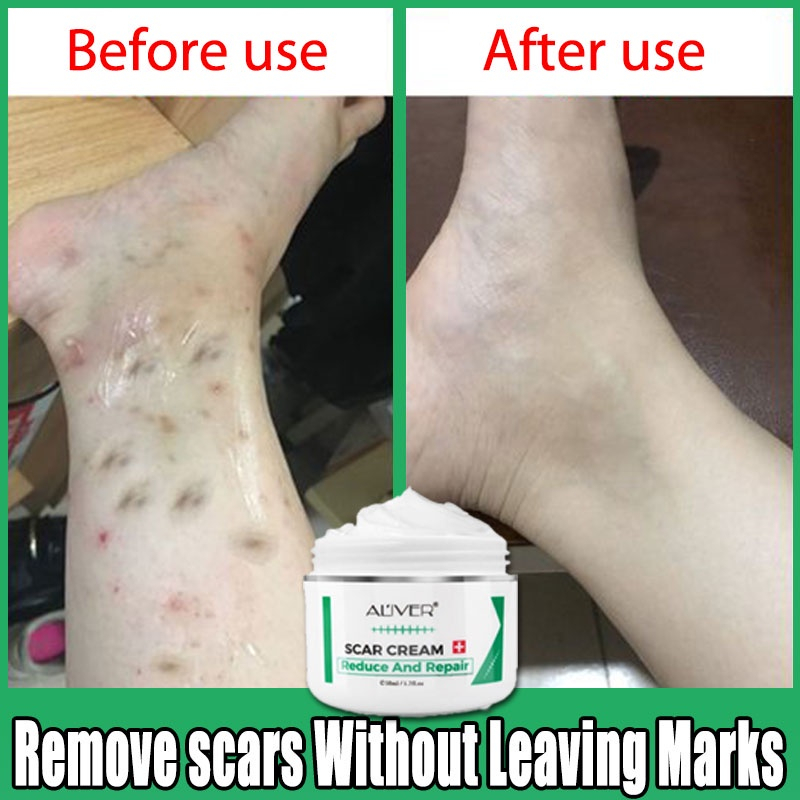 💯2 Weeks See The Effect💯ALIVER Natural Herbal Scar Remover Cream，Skin