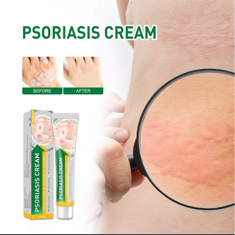 [SG INSTOCKS FAST SHIPPING] ECZEMA FUNGAL ITCHING BATERIAL INFECTIONS