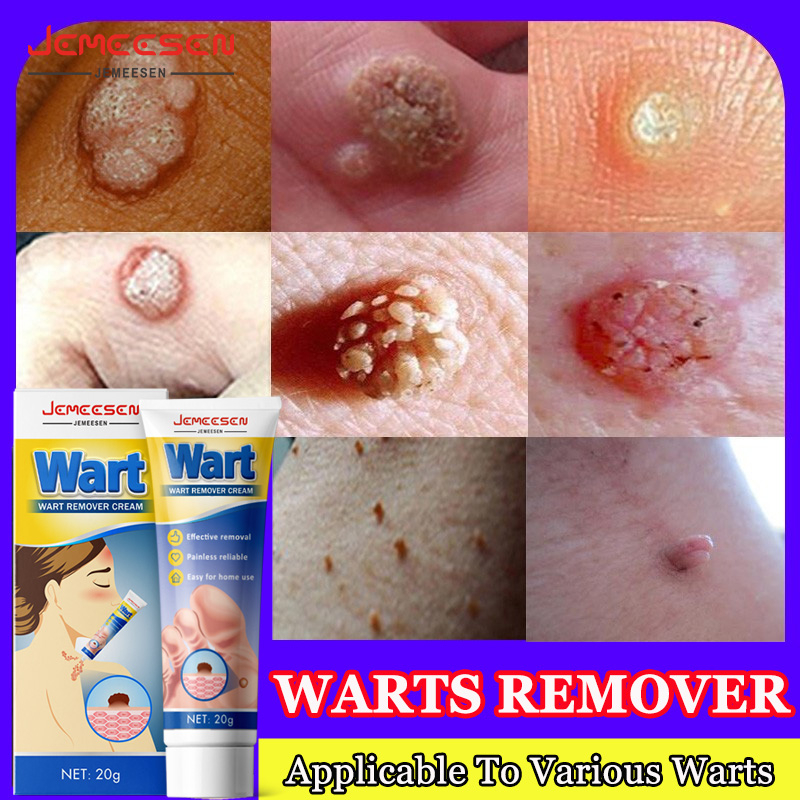 Jemeesen Skin Tag Remover 7 Days Effective Wart Removal Cream Painless ...