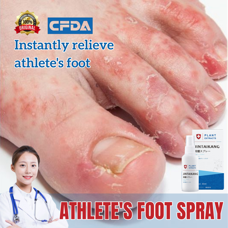 Athlete S Foot Spray Foot Odor Itchy Feet Peeling Blisters Treatment Beriberi Rotten Tinea Pedis