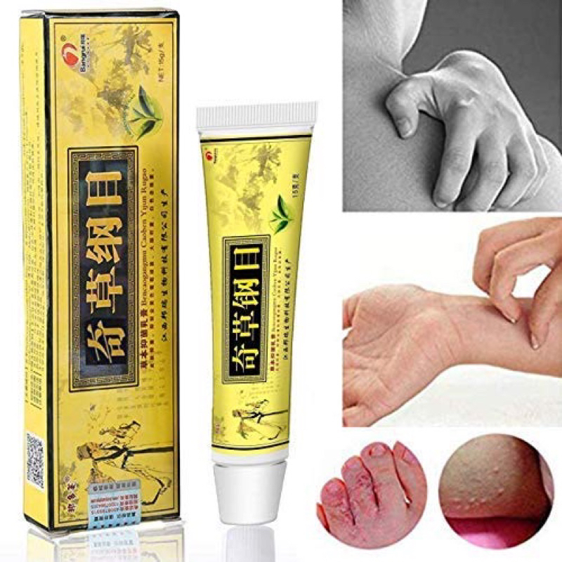 [SG INSTOCKS ] Antifungal / Itchy Eczema Anti-Itch Psoriasis Skin ...