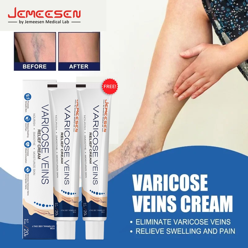 Jemeesen Varicose Veins Cream Removal Varacous Vein Spider Vein Pain ...