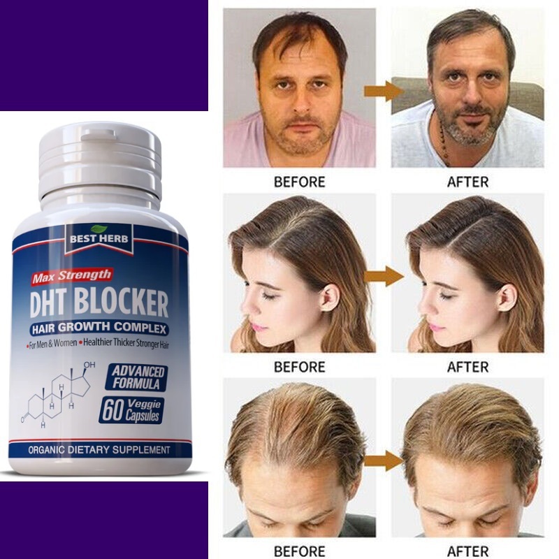 DHT BLOCKER HERBAL - HAIR MANAGEMENT- 60 VEGGIE CAPSULES | Shopee Singapore