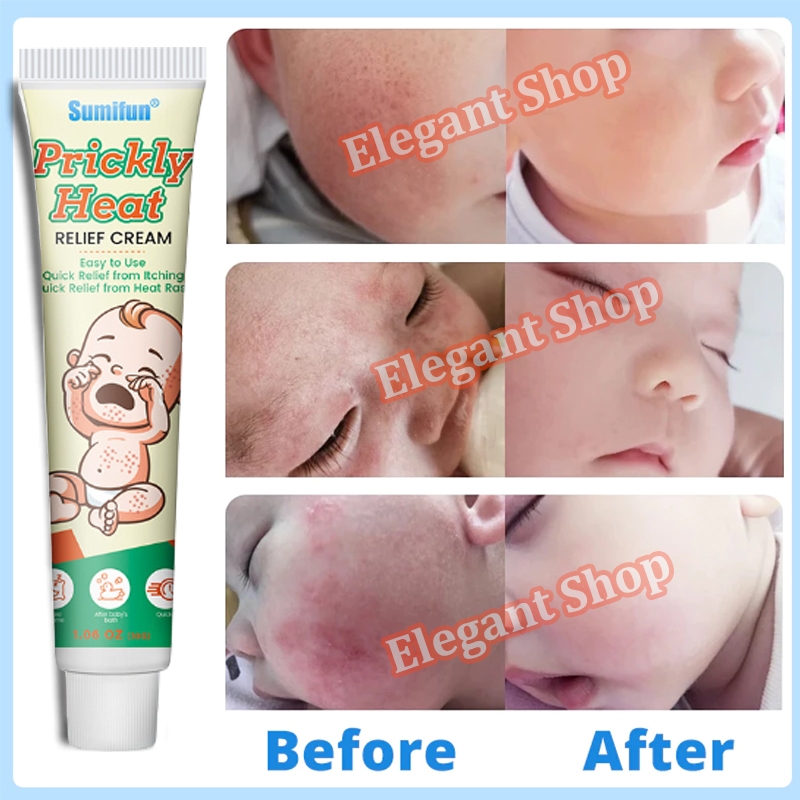 kids eczema cream Anti itch cream 30g Herbal Baby prickly heat cream ...