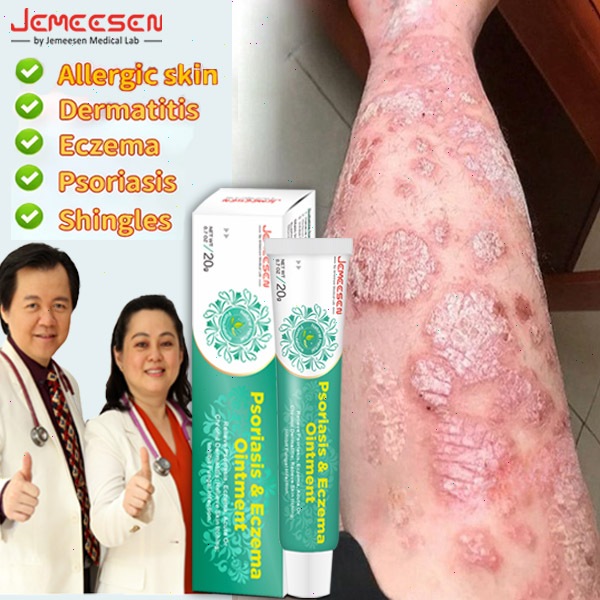 Jemeesen Psoriasis Ointment Eczema Cream For Itchy Skin Relief Gatal ...
