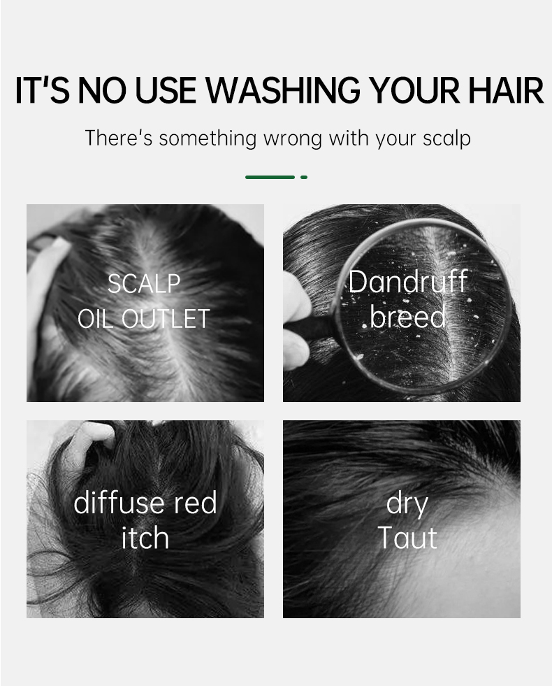 Scalp Treatment Shampoo Scalp Cleansing Anti Dandruff Remove Mite