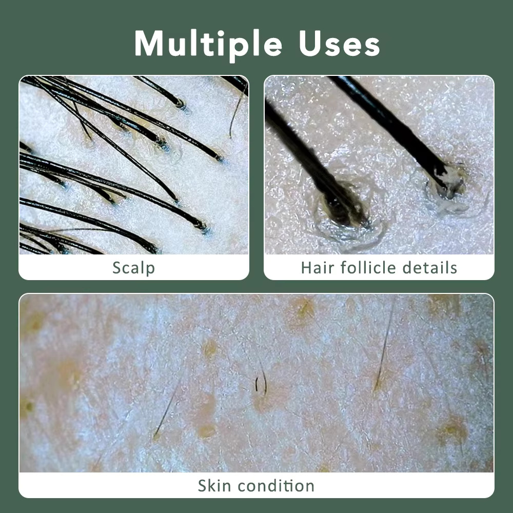 Hair Scalp Visual Dermoscope - Hi-Res Diagnostic Trichoscope - APP ...