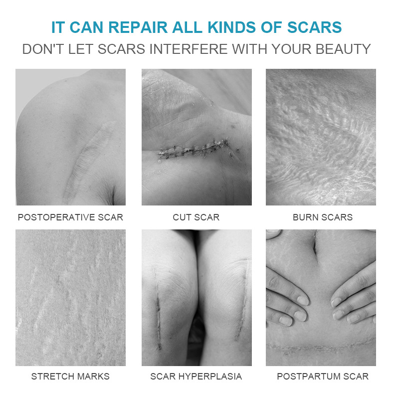 Keloid Scar Removal In Singapore: Treatment Review, Price – SYGMCR