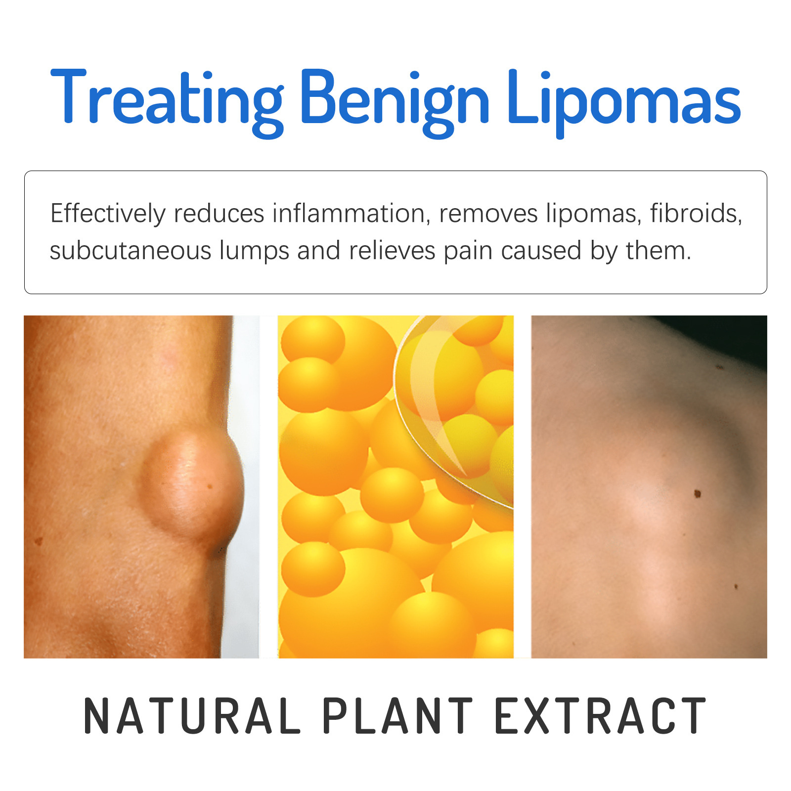 Lipoma Removal Cream Ointment Fat Granule Care External Swelling ...
