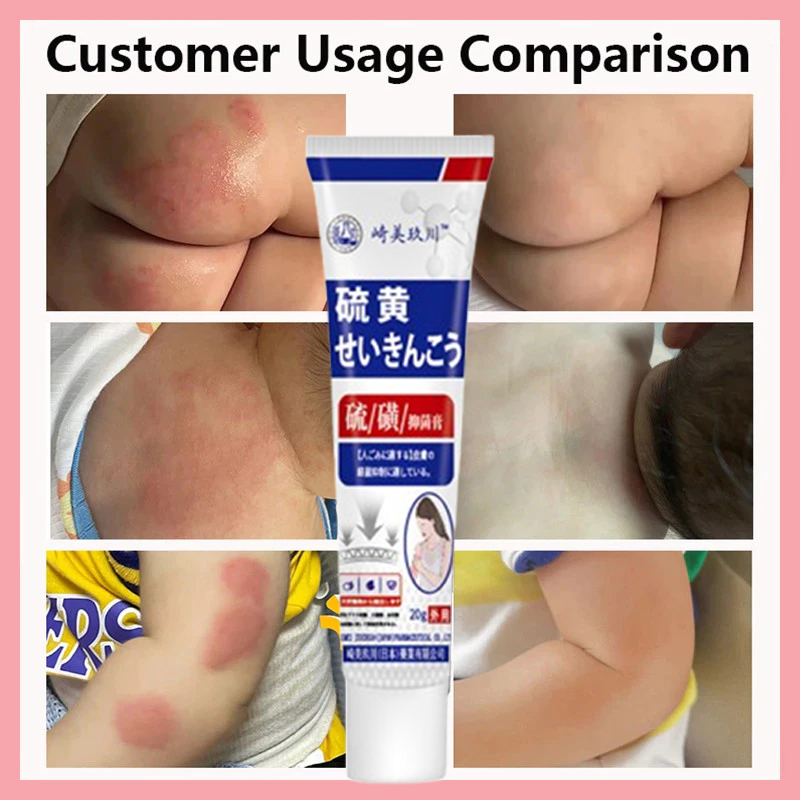 Japan Anti Itch Cream Eczema Cream Antifungal Cream Psoriasis ...