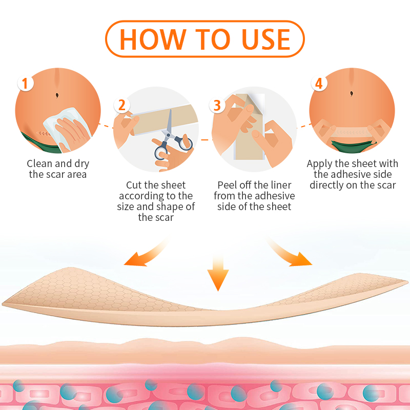 Flowweek Scar Patch Silicone Plaster Scar Removal Reuseable for C ...