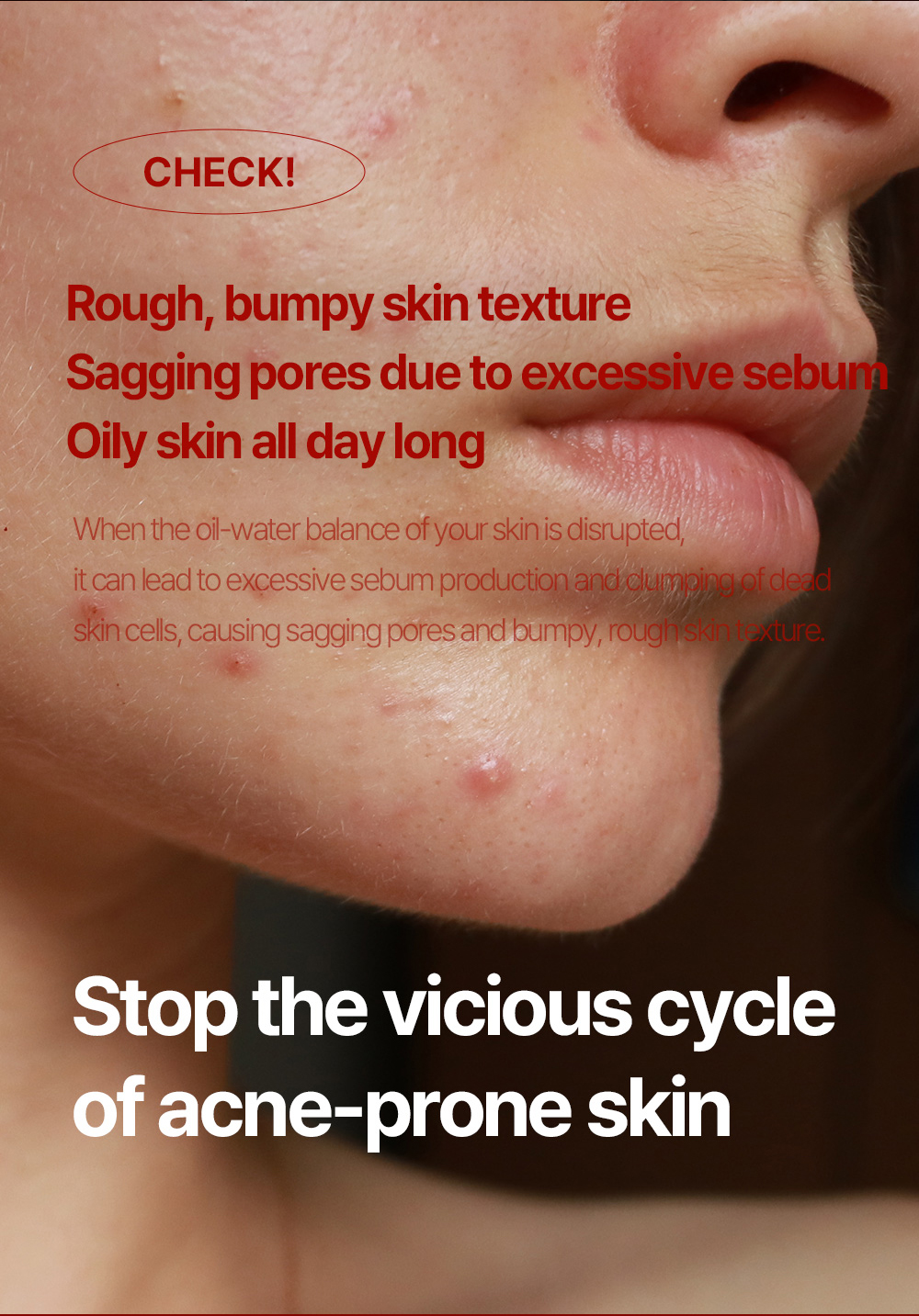 [Medisure] Rxcne 7-Day Terminate Cream 50ml - For Acne-Prone, Redness ...