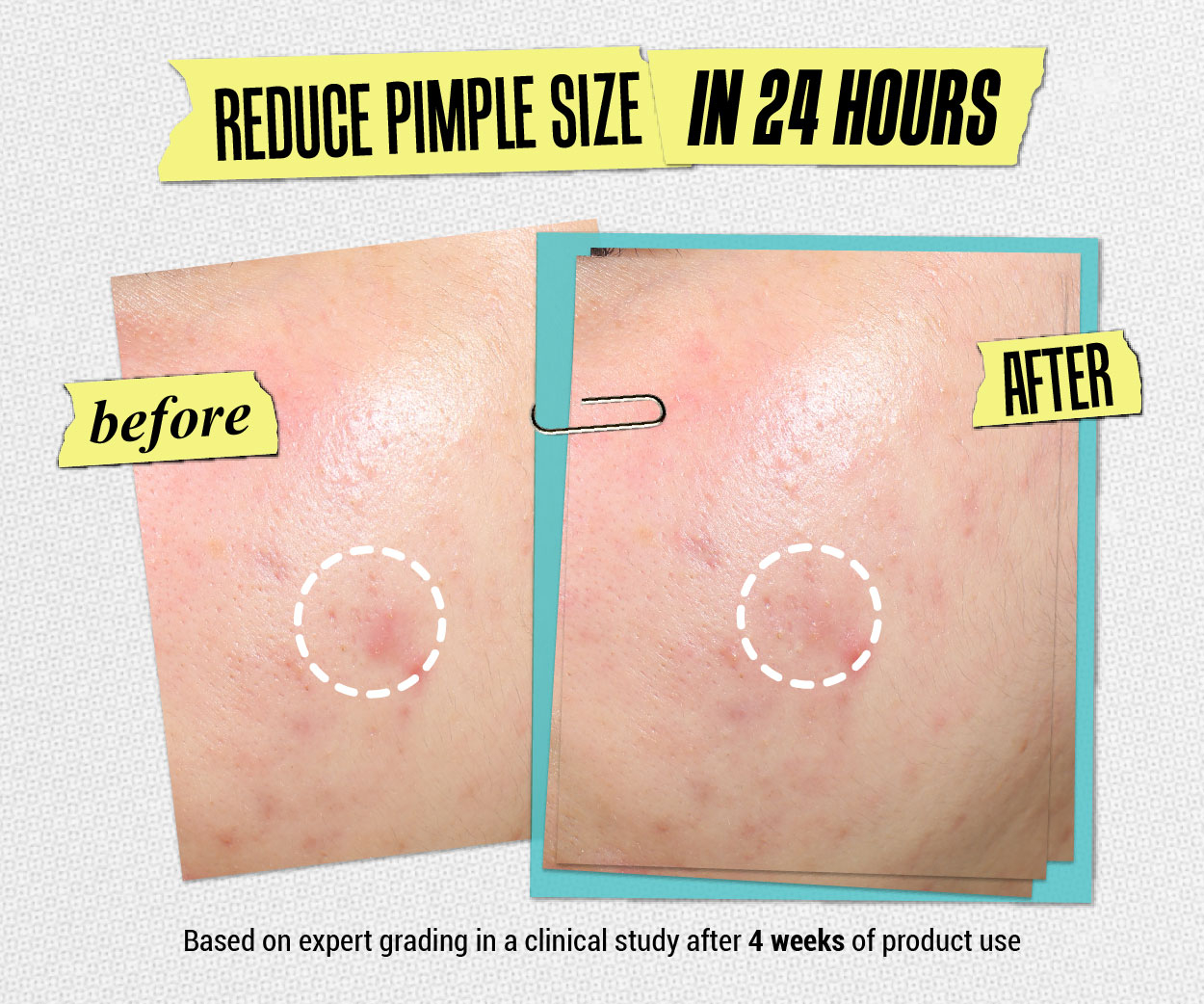 Kiehl's Truly Targeted Blemish-Clearing Solution Pimple Patch with ...
