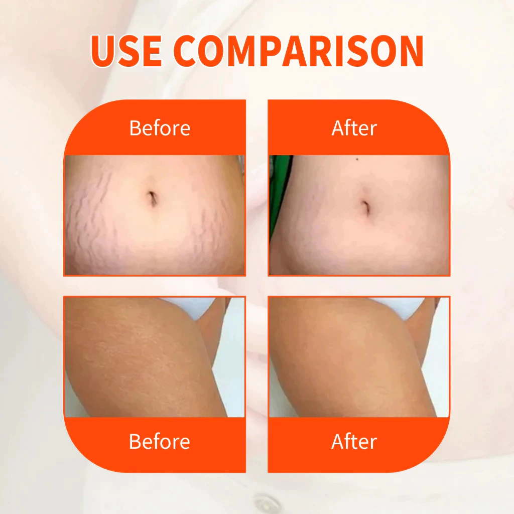 [SG In Stock] Bio-oil Skincare Oil 200ML Natural Formulation (For Scars ...