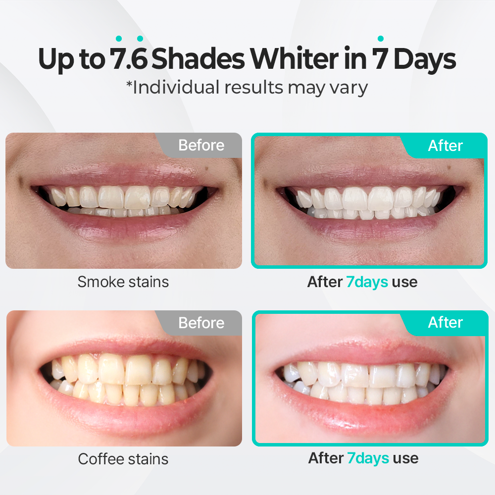 Liveorals Puredia Teeth Whitening Gel 10g 2 Weeks Supply Korea S No