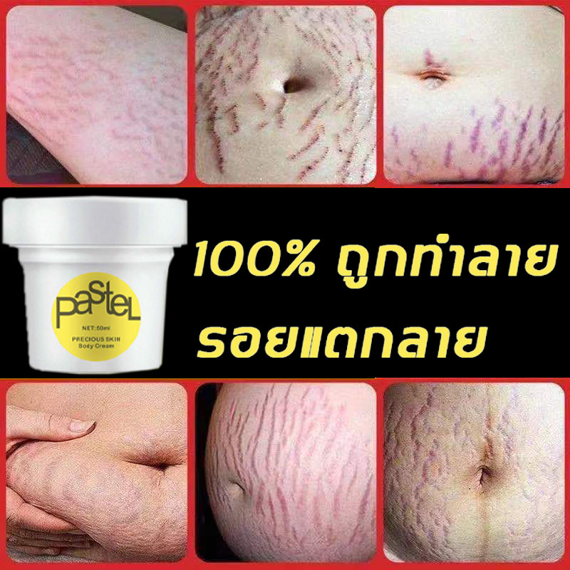 LILIAN Stretch Mark Cream 50G (Snail To Cure Legs Marks Marks) Shopee