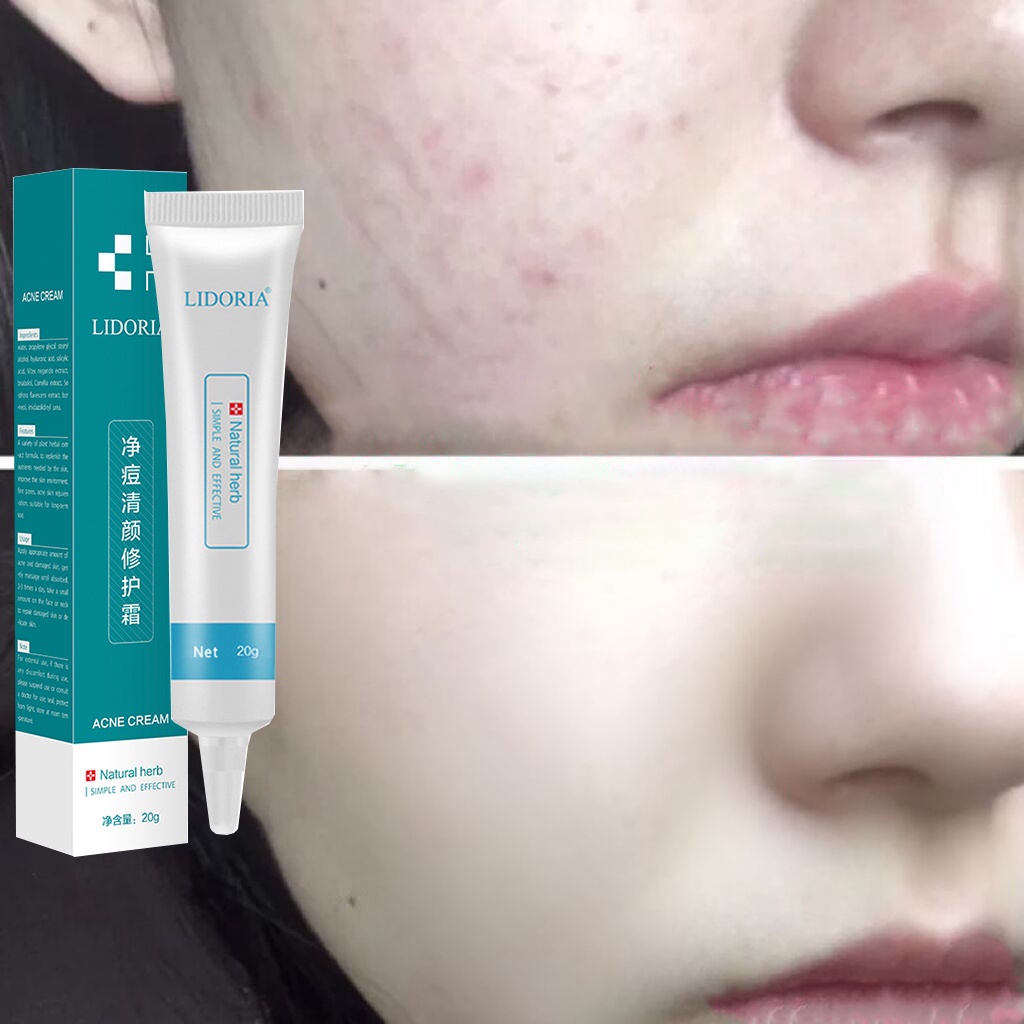 Acne Reduction Cream Acne Cream 20g AntiAcne gel Blurring Acne