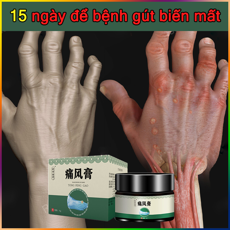 35g Osteoarthritis Pain Cream Eliminates Finger And Toe Pain Gout uric