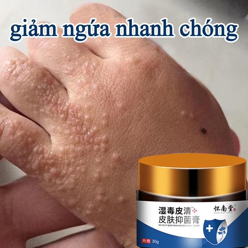 Herbal Ringworm Cream 30ml Reduces Fungal Infections And Skin Moss To