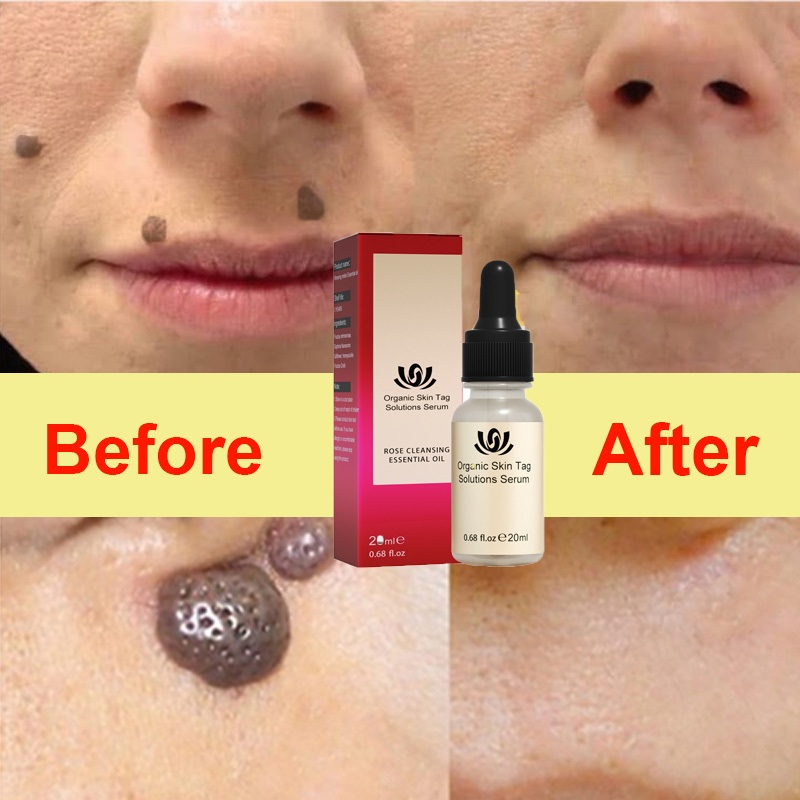 Mole Removal Cream, Warts Remove Mole On The Face, Warts And Moles