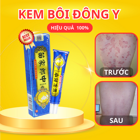 Itchy Fungus Topical Cream to Support Ringworm, Psoriasis, Ringworm ...