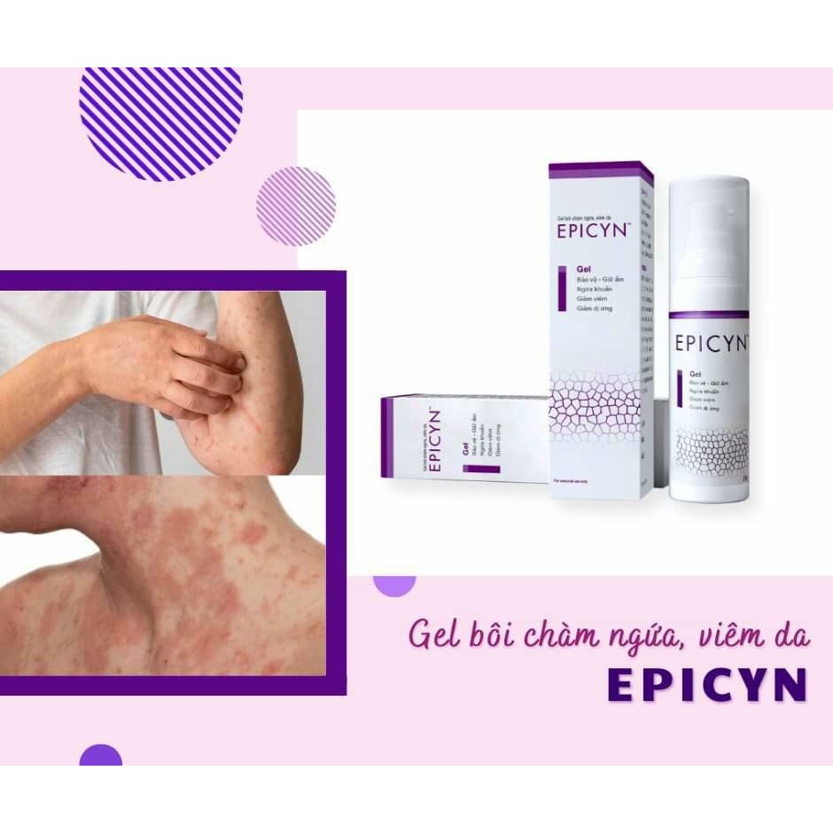 Gel for atopic dermatitis, itchy eczema, psoriasis, allergic dermatitis ...
